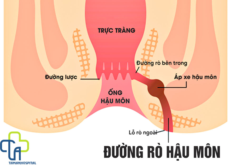 Bệnh lý rò hậu môn